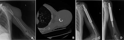 Orthopedic therapeutic surgery for bone metastasis of liver cancer: Clinical efficacy and prognostic factors